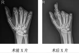 隔着屏幕都疼！49岁惠州女子脚趾“移花接木”变手指图片