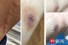 【有事找紫牛】女子抽脂后伤口处鼓包化脓，美容医院：不能证明感染是手术引起，正与患者积极沟通图片
