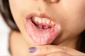 反复口腔溃疡，可能不是单纯的“上火”！这种病要小心！图片