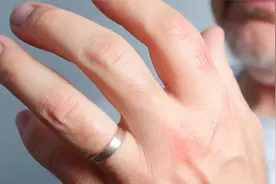 经常手麻、脚麻是中风前兆？不一定，还有这5种病症与其相关，需引起重视图片