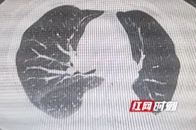 气道狭窄仅剩“一线”空间 这项治疗助八旬老太呼吸顺畅图片