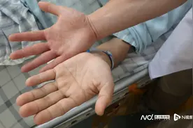 容貌改变、手足增大？警惕这种让患者手脚变粗、变丑的罕见病图片