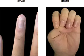 氘可来昔替尼真实世界表现令人振奋，助力中国银屑病患者个体化治疗图片