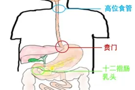 内镜超级微创：器官保留疗效好，让患者绝处逢生图片