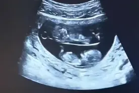 孕妇做B超拍到宝宝住“上下铺”，专家表示这么规整地上下“分房”并不多见图片