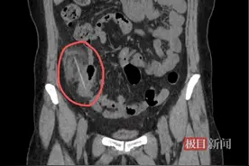 痛失十厘米肠道！女子腹痛五天急就医，竟是意外吞下的牙签刺穿肠道图片
