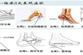 【健康科普】足跟痛，不要觉得“忍忍就好”图片