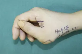 多指畸形手术后为啥仍畸形？专家提醒手术方案很重要图片