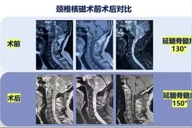 58岁颅底凹陷患者手部肌肉萎缩、下肢无力需拄拐，脊柱外科巧解难题图片