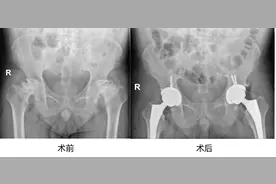 49岁男子股骨头坏死，原因竟与这个不良生活习惯有关！图片