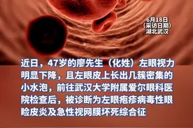 男子眼痛难忍看不清，原是带状疱疹长到了眼睛里图片