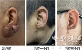 耳朵处长出“肉疙瘩” 专家出手解决“七年困扰”图片