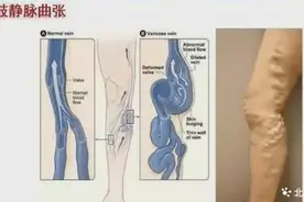 【杨柳科普】静脉曲张不只会毁美腿！3个并发症可能让你后悔图片