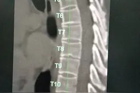 CT+AI，骨密度检测一步到位！图片