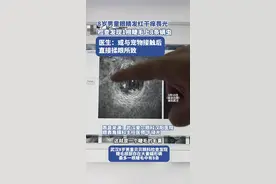 8岁男童眼睛发红干痒还畏光，检查发现一根睫毛上有8条螨虫，医生：或是与宠物接触后直接揉眼所致图片