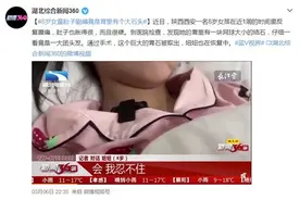 浙江一5岁女孩确诊长发公主综合征：胃里一大团头发，手术3小时清理干净图片