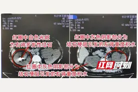 结石梗阻引发双肾积水 女子自行吃草药排石数月险酿大祸图片