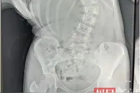 女孩一条裤腿突然“长半截”，一查竟是脊柱侧弯45度图片