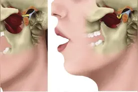 突然张不开嘴？吃东西耳边有声响？颞下颌关节紊乱病了解一下丨健康智慧屋图片