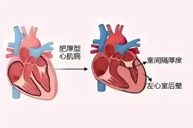 “肥厚”心脏迎新机 全球首创心肌肌球蛋白抑制剂在国内上市图片