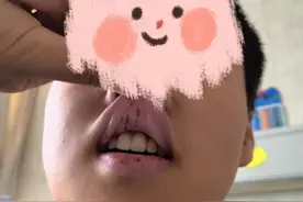 孩子脸部、手脚长黑斑 专家：警惕癌变！图片