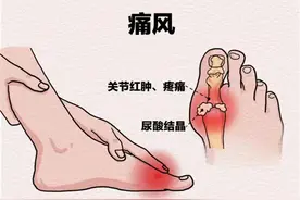 尿酸高就会痛风吗？松山医院：超过这个值要警惕图片