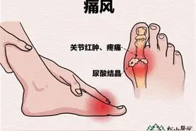 尿酸高就会痛风吗？松山医院：超过这个值要警惕图片