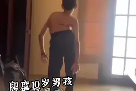 印度“折叠”男孩 上海求医获新生图片