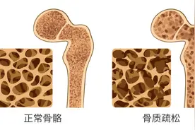 警惕“骨骼危机”！女性补钙黄金期从35岁开始图片