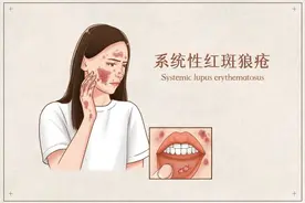 最近大家又在关注的红斑狼疮，这些知识听专家来解答→图片