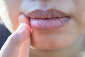 嘴唇干裂别急着喝水，可能是缺这种维生素！80%都忽略了，难怪好得慢！图片