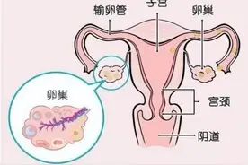 上海本土企业突破卵巢癌诊疗困境，技术进入早筛共识图片