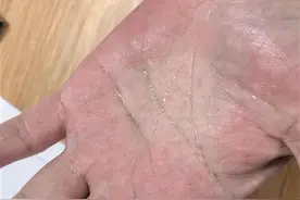 男子每天挥汗如雨，手心湿漉漉，医生射频术治好多汗症图片