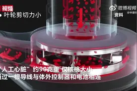 武汉一男子成功植入国产人工心脏，仅核桃大小！图片
