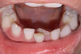 孩子“双排牙”越来越多了，需要拔牙矫正吗？图片