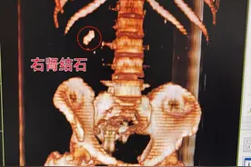 腰痛到呕吐，竟是“潜伏”4年的它发作了！医生：这些生活习惯赶紧改图片