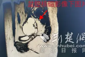惊悚！未婚女子体内取出苹果大“怪胎” 里面竟还长着毛发牙齿骨骼图片