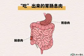 息肉和癌是“近亲”？松山医院：防治息肉三步走图片