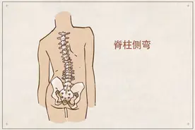 18岁少女脊柱严重侧弯！这种最舒服的睡姿，会把身体睡垮……图片