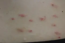 女子一觉醒来，身上密密麻麻！近期高发，家中有它要格外注意图片