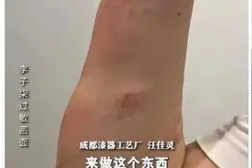 热搜！李子柒为拍视频皮肤过敏结痂，听听专家怎么说图片