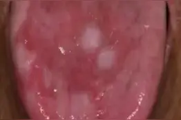 【“人民”科普】口腔黏膜有变化别大意！可能是健康隐患|世界口腔健康日图片
