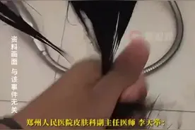 男子一月染头4次致头发大量脱落 医生：烫染头发一年不要超过2次图片