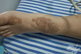 咳嗽一周竟突发心梗，小伙在ICU捡回一条命！这个病死亡风险很高图片