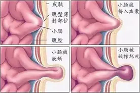 【首都除夕护卫健康】关爱老年疝气患者：春节期间的隐形风险图片
