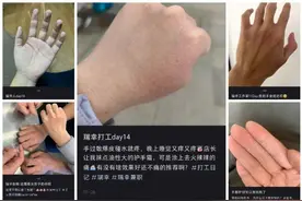 瑞幸近15000家门店背后竟是咖啡师烂手之痛，算工伤吗？图片