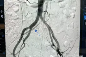 【病例报告】International Urology and Nephrology｜一例关于髂血管输尿管瘘的病例报告图片