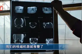 惊险！大庆一男子眼中取出藏了多年的“铁钉”！图片
