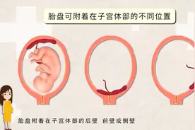 视频｜有问医答：孕期胎盘低置该怎么办？图片