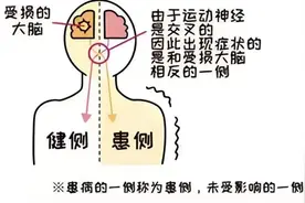 康复之路！偏瘫综合征患者的上肢康复训练方法科普→图片